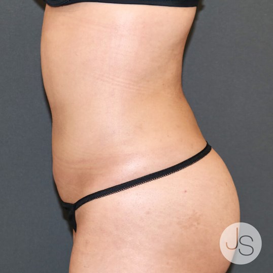 Liposuction (Smooth Lipo) Before and After Pictures Beverly Hills, CA