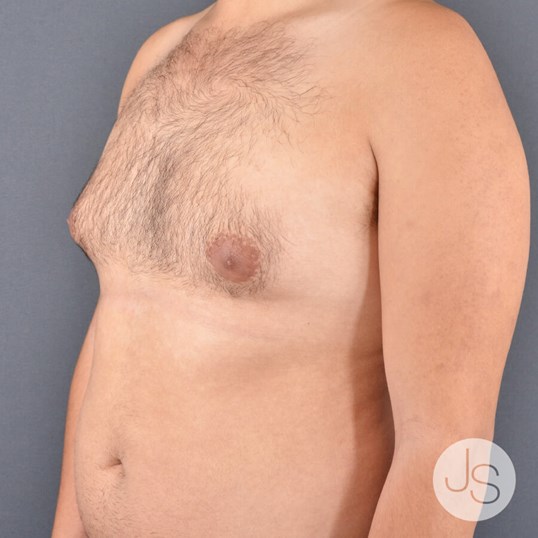 Liposuction (Smooth Lipo) Before and After Pictures Beverly Hills, CA