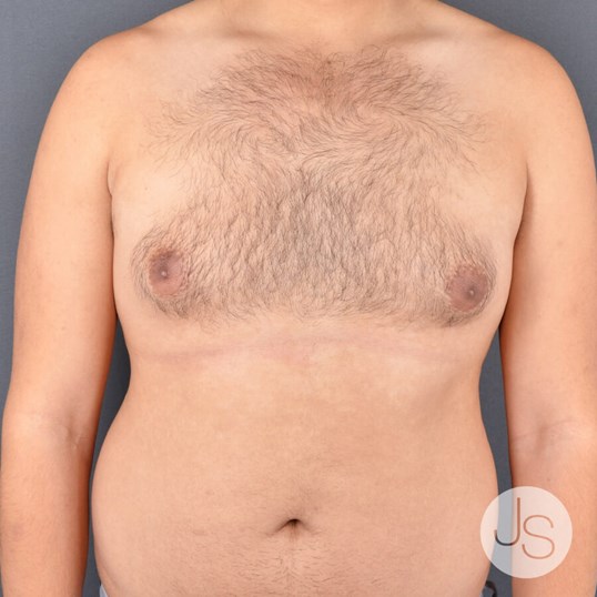 Liposuction (Smooth Lipo) Before and After Pictures Beverly Hills, CA