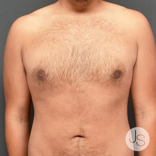 Liposuction (Smooth Lipo) Before and After Pictures Beverly Hills, CA