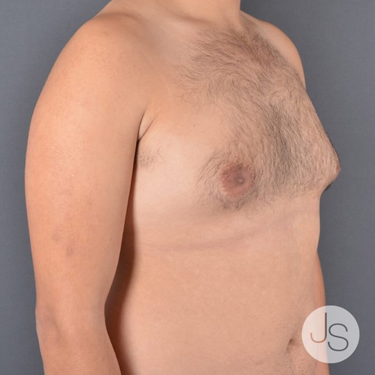 Liposuction (Smooth Lipo) Before and After Pictures Beverly Hills, CA