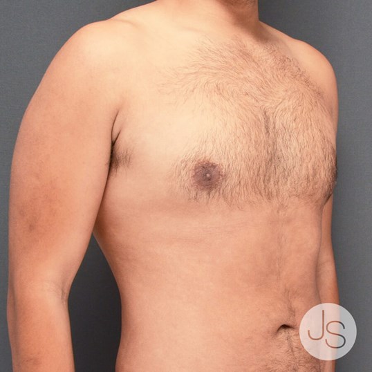 Liposuction (Smooth Lipo) Before and After Pictures Beverly Hills, CA