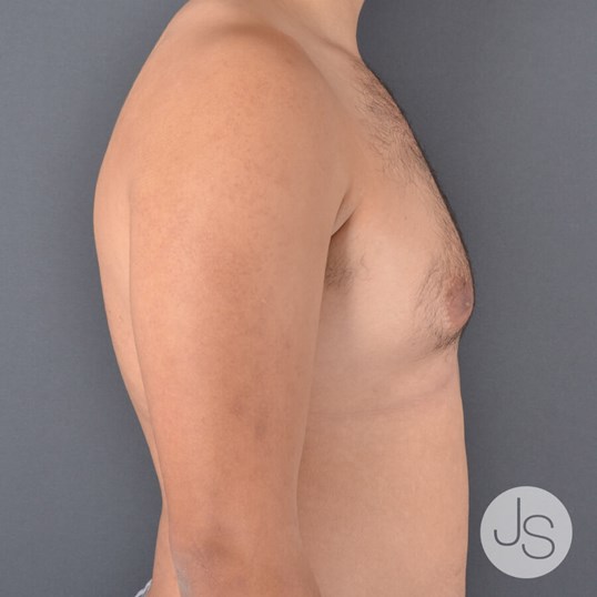 Liposuction (Smooth Lipo) Before and After Pictures Beverly Hills, CA