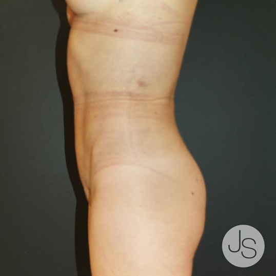 Liposuction (Smooth Lipo) Before and After Pictures Beverly Hills, CA