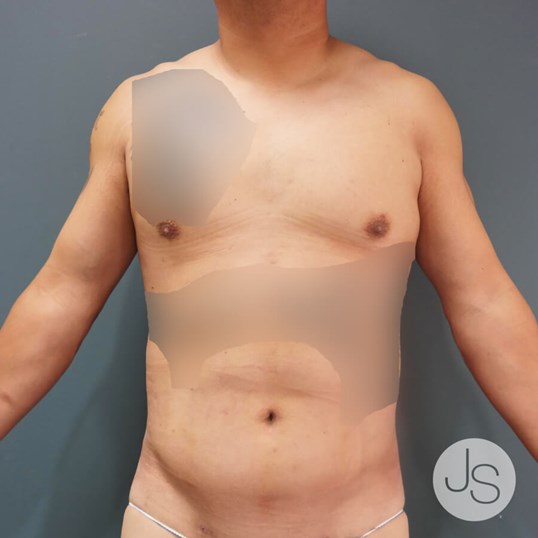 Liposuction (Smooth Lipo) Before and After Pictures Beverly Hills, CA