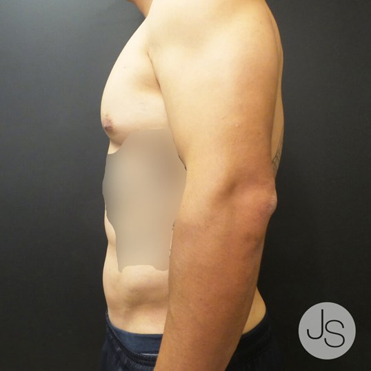 Liposuction (Smooth Lipo) Before and After Pictures Beverly Hills, CA