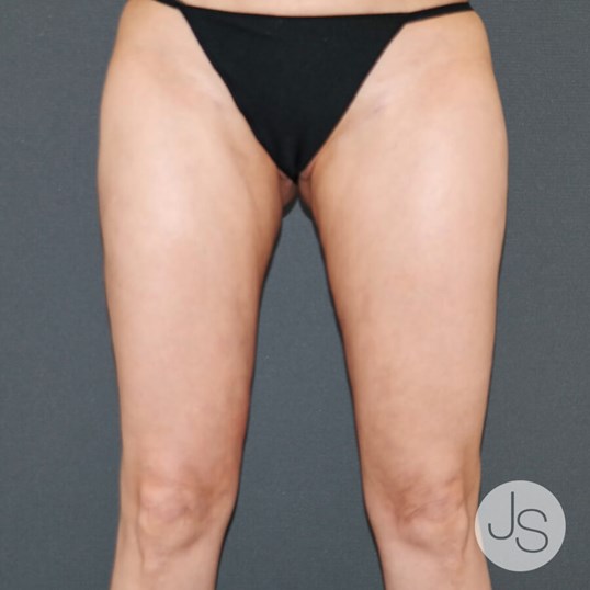 Liposuction (Smooth Lipo) Before and After Pictures Beverly Hills, CA