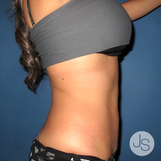 Liposuction (Smooth Lipo) Before and After Pictures Beverly Hills, CA