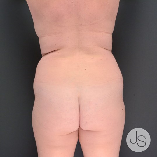 Liposuction (Smooth Lipo) Before and After Pictures Beverly Hills, CA