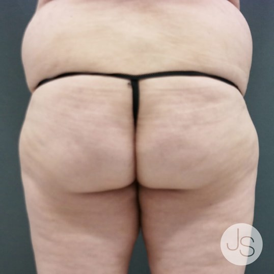 Liposuction (Smooth Lipo) Before and After Pictures Beverly Hills, CA