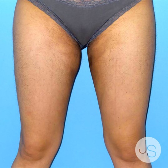 Liposuction (Smooth Lipo) Before and After Pictures Beverly Hills, CA