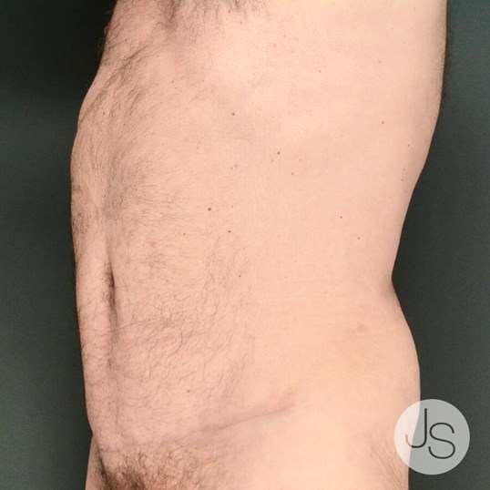 Liposuction (Smooth Lipo) Before and After Pictures Beverly Hills, CA