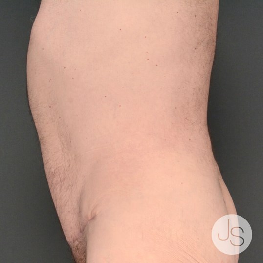 Liposuction (Smooth Lipo) Before and After Pictures Beverly Hills, CA