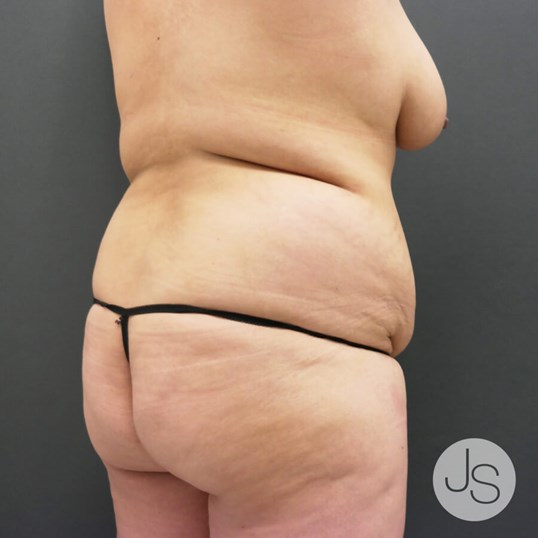 Brazilian Butt Lift Before and After Pictures Beverly Hills, CA