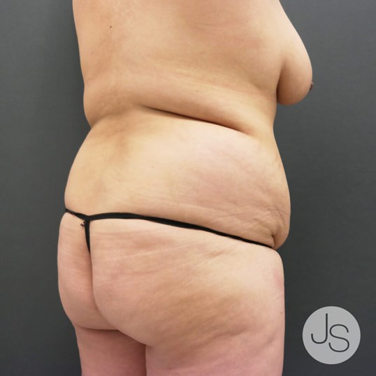 Brazilian Butt Lift Before and After Pictures Beverly Hills, CA