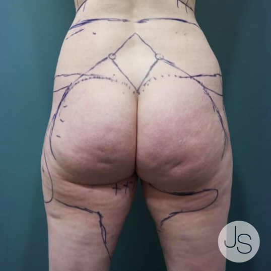 Brazilian Butt Lift Before and After Pictures Beverly Hills, CA