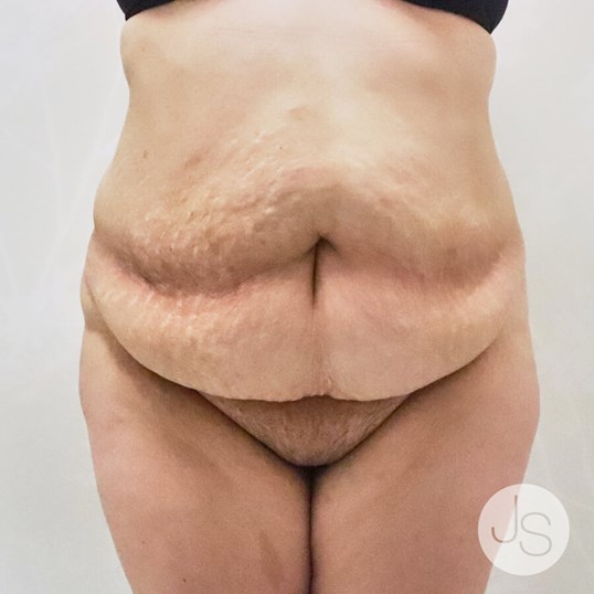 Tummy Tuck Before and After Pictures Beverly Hills, CA