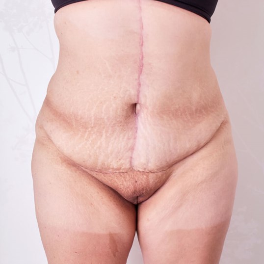 Liposuction (Smooth Lipo) Before and After Pictures Beverly Hills, CA