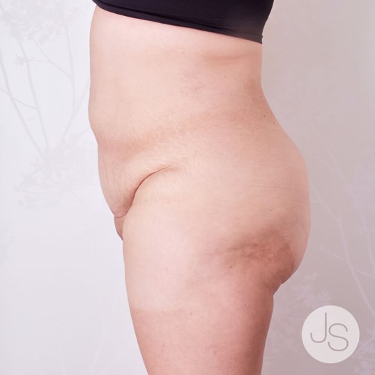 Liposuction (Smooth Lipo) Before and After Pictures Beverly Hills, CA