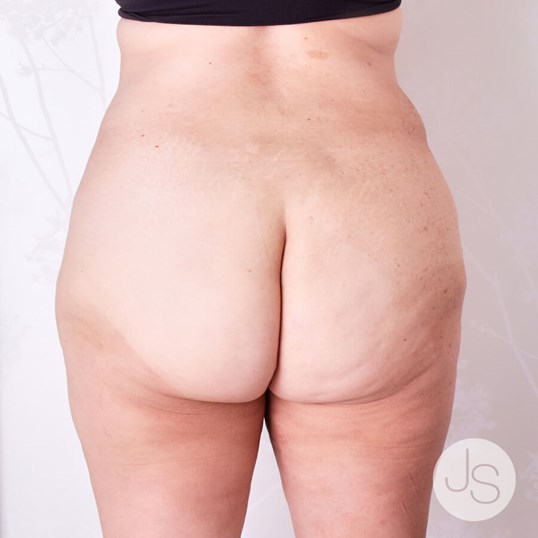 Liposuction (Smooth Lipo) Before and After Pictures Beverly Hills, CA