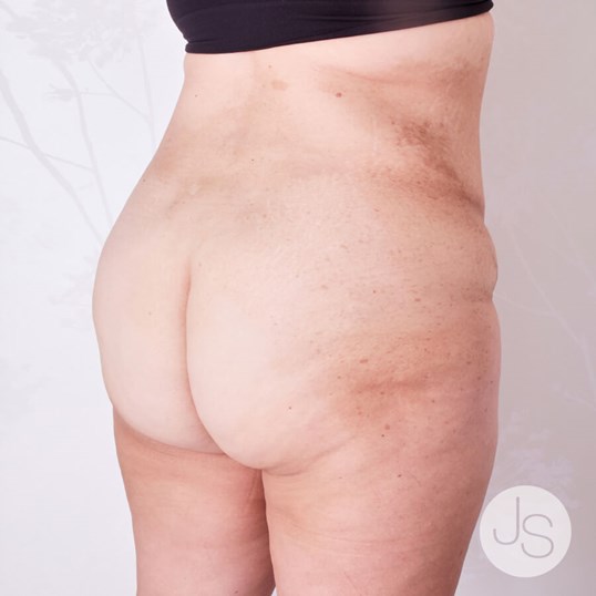 Liposuction (Smooth Lipo) Before and After Pictures Beverly Hills, CA