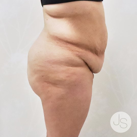 Liposuction (Smooth Lipo) Before and After Pictures Beverly Hills, CA