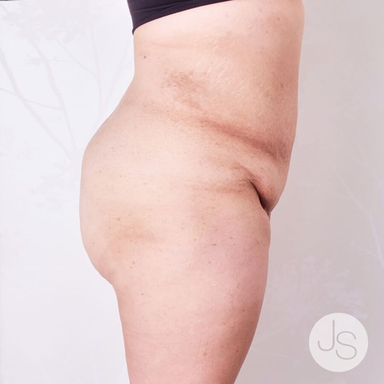 Liposuction (Smooth Lipo) Before and After Pictures Beverly Hills, CA