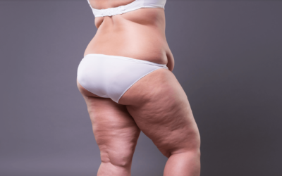How Long Is The Recovery After Extreme Weight Loss Surgery?