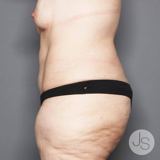 Tummy Tuck Before and After Pictures Beverly Hills, CA