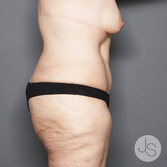 Tummy Tuck Before and After Pictures Beverly Hills, CA