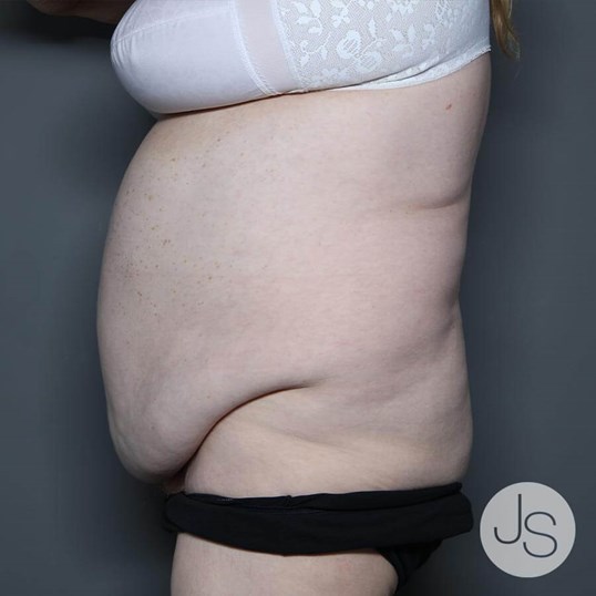 Tummy Tuck Before and After Pictures Beverly Hills, CA