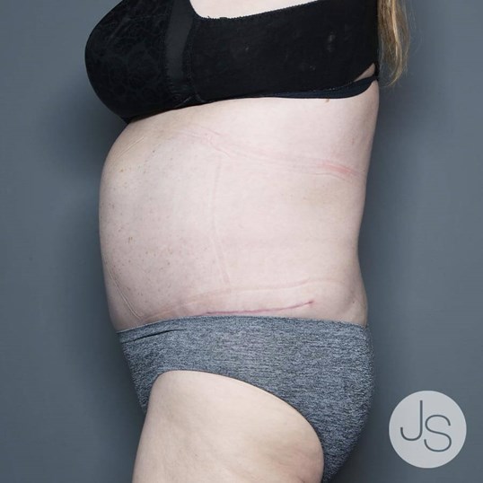 Tummy Tuck Before and After Pictures Beverly Hills, CA