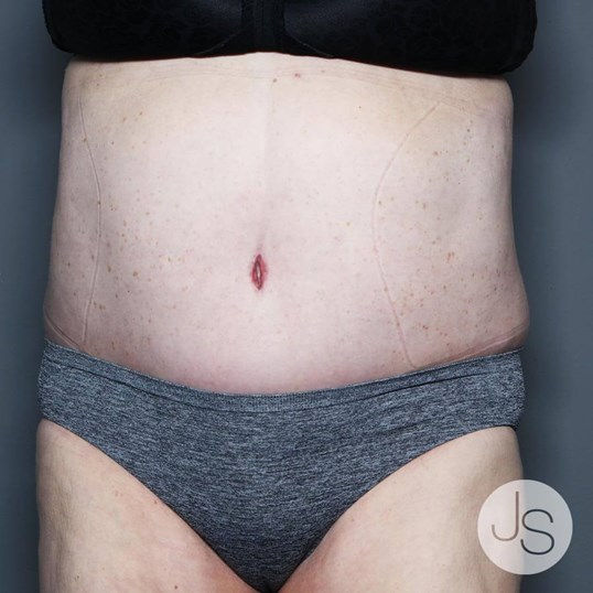 Tummy Tuck Before and After Pictures Beverly Hills, CA