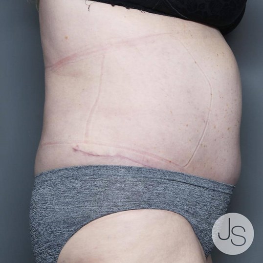 Tummy Tuck Before and After Pictures Beverly Hills, CA