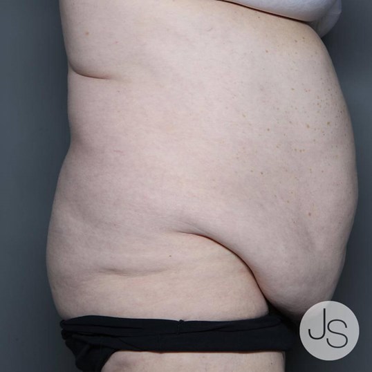 After Weight Loss Surgery Before and After Pictures Beverly Hills, CA
