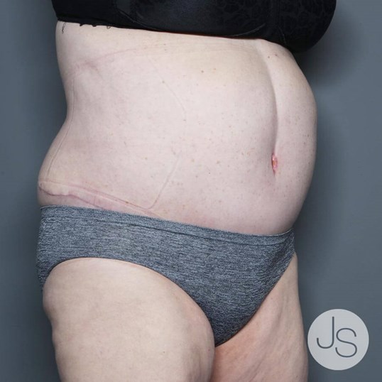 Tummy Tuck Before and After Pictures Beverly Hills, CA