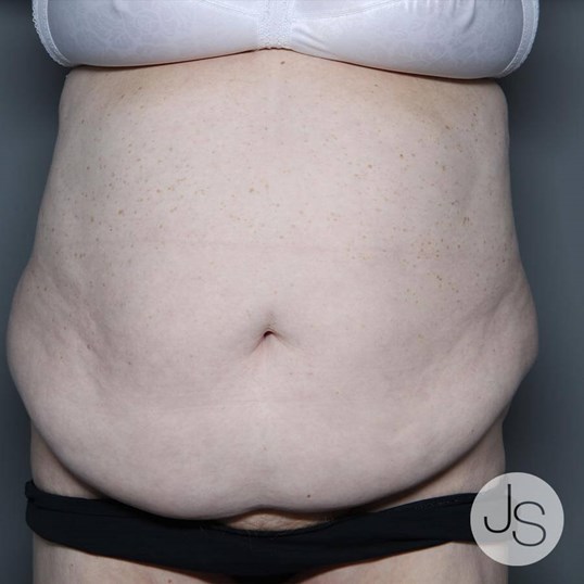 Tummy Tuck Before and After Pictures Beverly Hills, CA