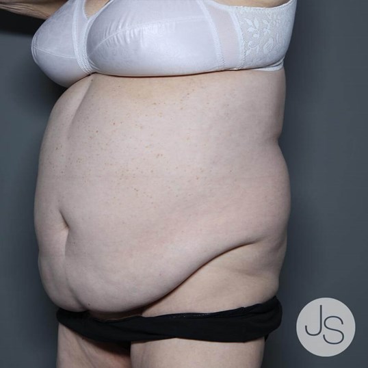 Tummy Tuck Before and After Pictures Beverly Hills, CA