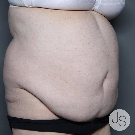 Tummy Tuck Before and After Pictures Beverly Hills, CA