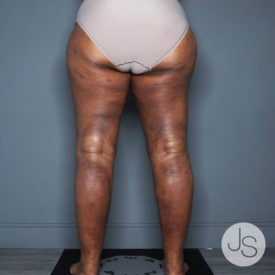 Liposuction (Smooth Lipo) Before and After Pictures Beverly Hills, CA