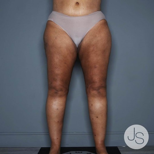 Liposuction (Smooth Lipo) Before and After Pictures Beverly Hills, CA