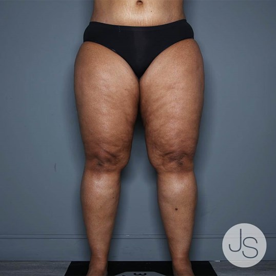 Liposuction (Smooth Lipo) Before and After Pictures Beverly Hills, CA