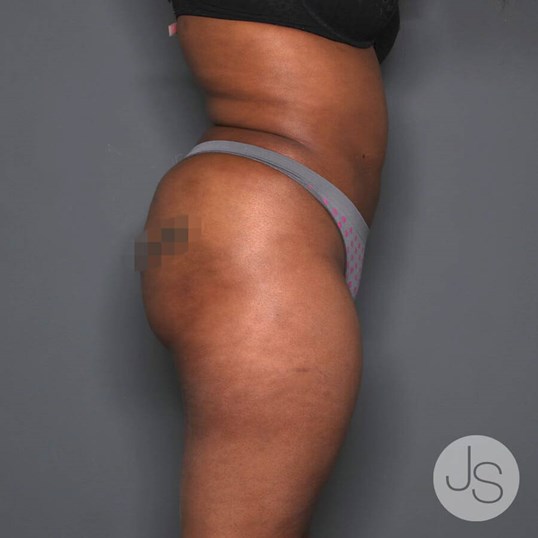 Liposuction (Smooth Lipo) Before and After Pictures Beverly Hills, CA