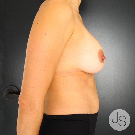 Breast Lift Before and After Pictures Beverly Hills, CA