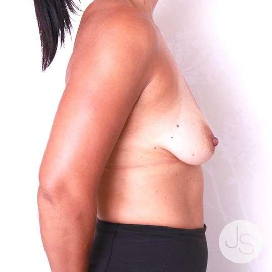 Breast Lift Before and After Pictures Beverly Hills, CA