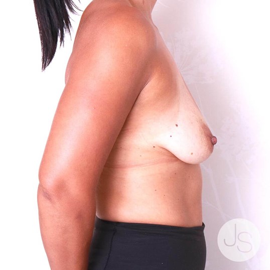 Breast Augmentation Before and After Pictures Beverly Hills, CA