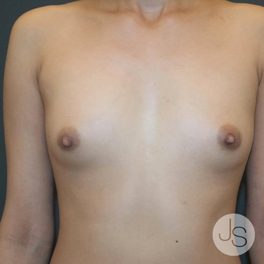 Breast Augmentation Before and After Pictures Beverly Hills, CA