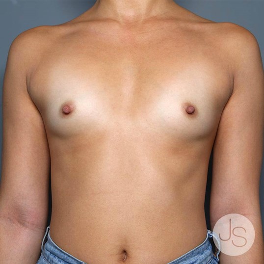 Breast Augmentation Before and After Pictures Beverly Hills, CA