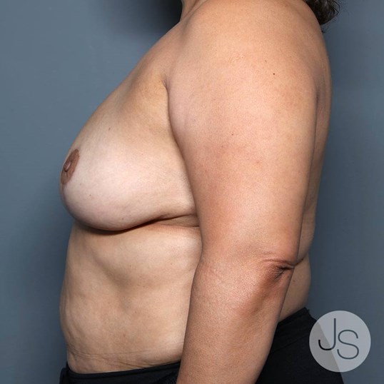 Breast Reduction Before and After Pictures Beverly Hills, CA