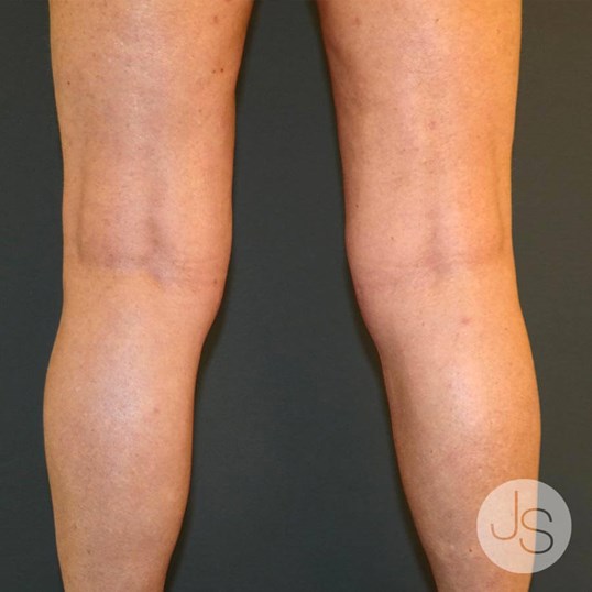 Liposuction (Smooth Lipo) Before and After Pictures Beverly Hills, CA